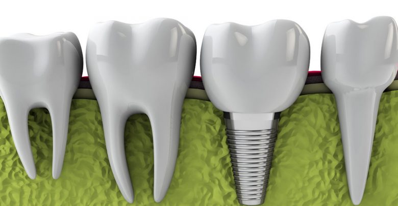 Candidate of Dental Implants