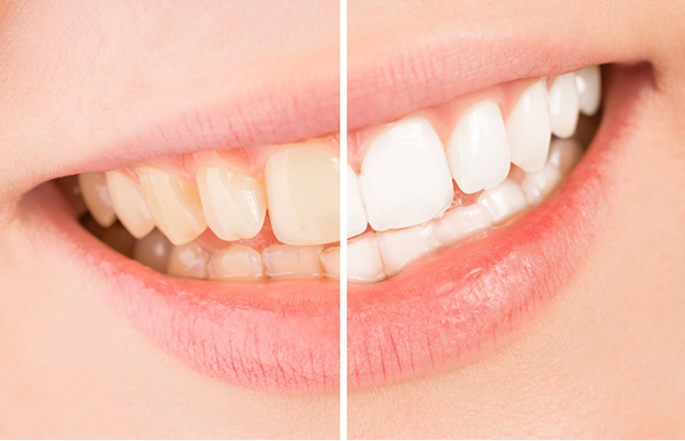 What Type of Dental Health Issues Can Cause Tooth Discoloration?